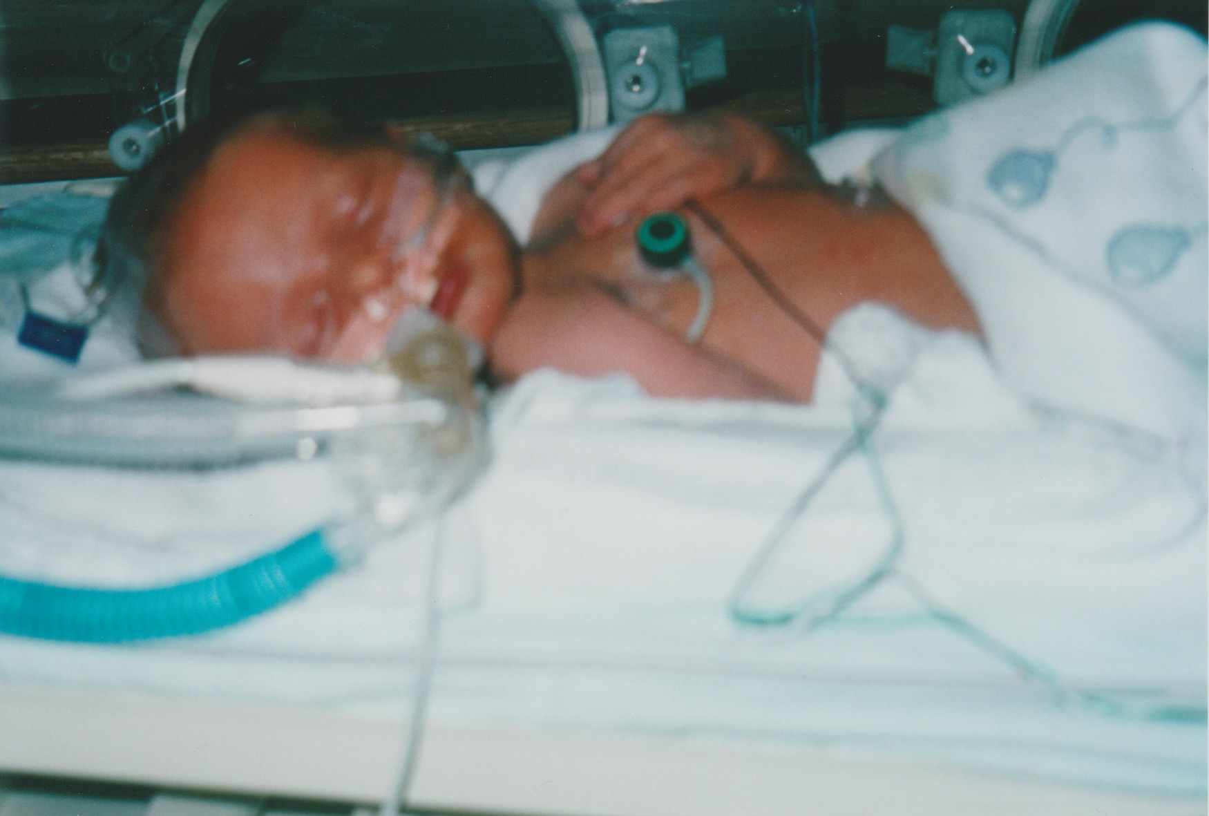 Before Trach McMaster Hospital